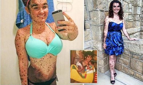 Bullied Teen With Rare Skin Condition: "I'm So Proud to Be Different"
