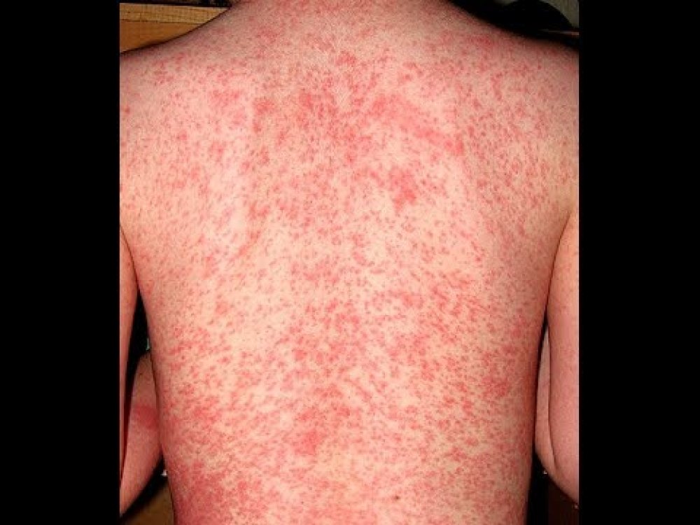 How to eliminate the annoying scabies