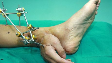 Médicos implantaron una mano en un tobillo para que mantenga irrigación sanguínea
