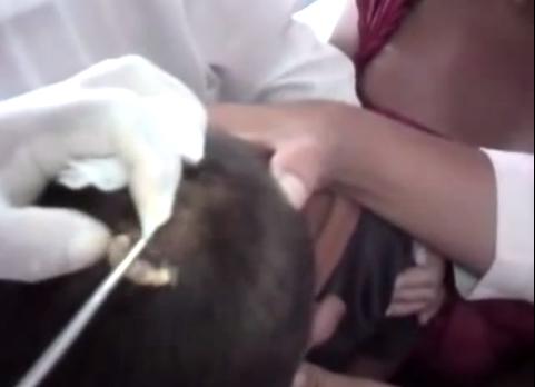 Medico le extrae un enorme gusano a un niño de su cabeza  