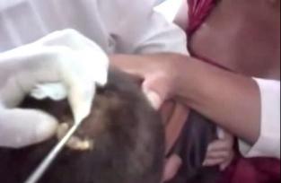 Medico le extrae un enorme gusano a un niño de su cabeza  