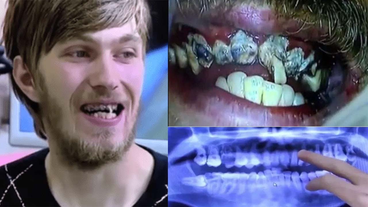 This man has not brushed his teeth for over 20 years