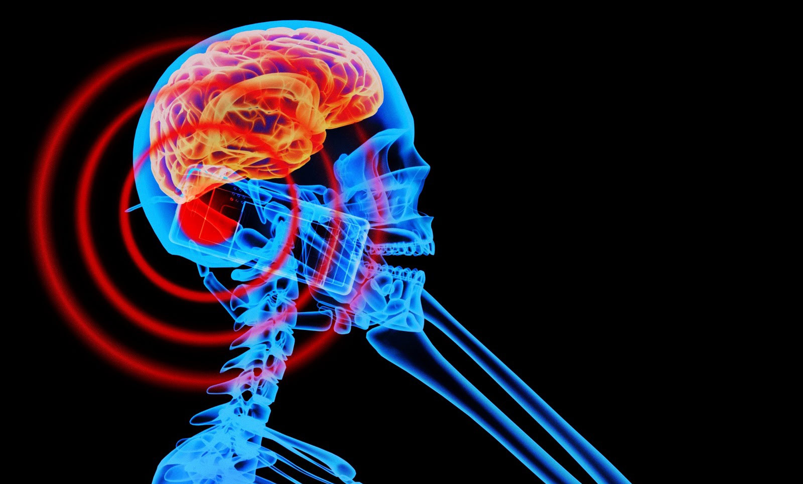 How cellphones can cause brain tumors and trigger chronic disease