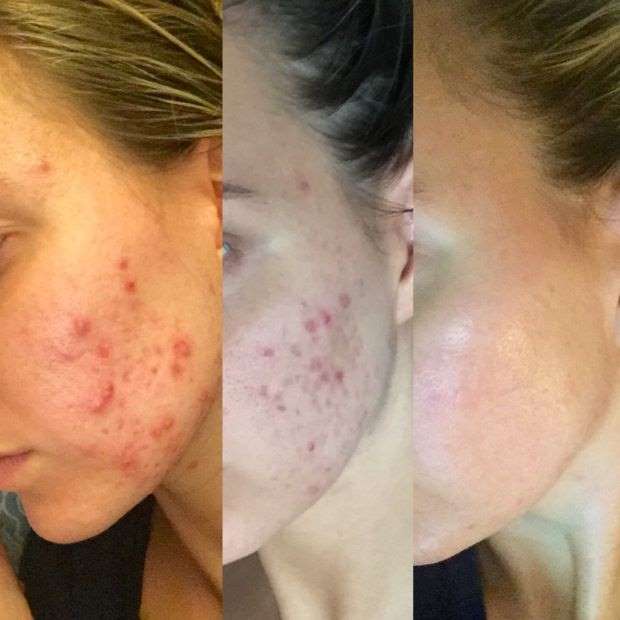 'My acne basically disappeared after I cut out gluten, sugar, and dairy'
