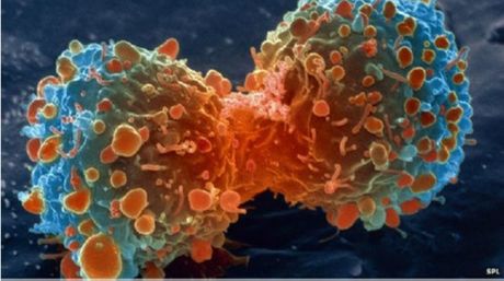 Nueva investigación asegura que la mayoría de los cánceres son el resultado de la "mala suerte"