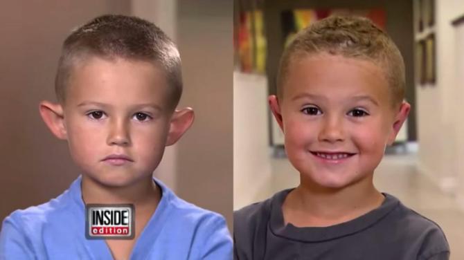 Parents get their six year old son plastic surgery after bullies tease him