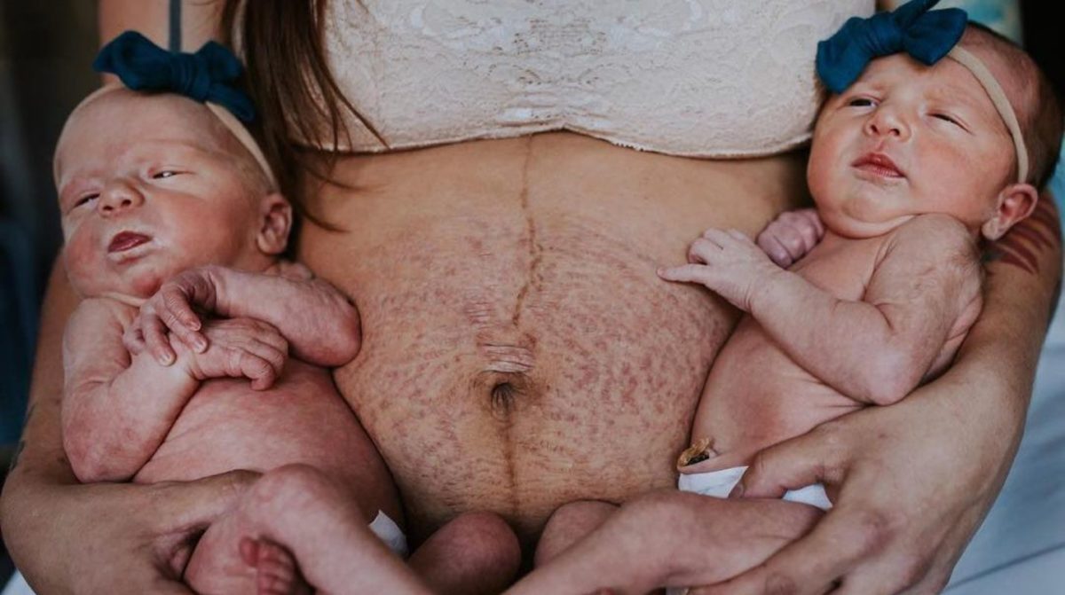 Letter from a mother to her son about the marks of her pregnancy