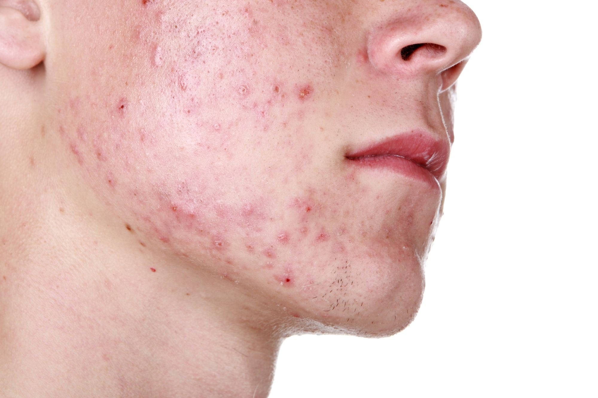 Home remedies to prevent acne