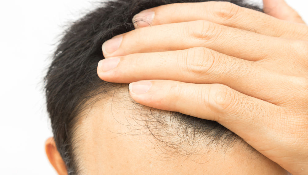 5 señales que indican que la caída de tu pelo debe preocuparte