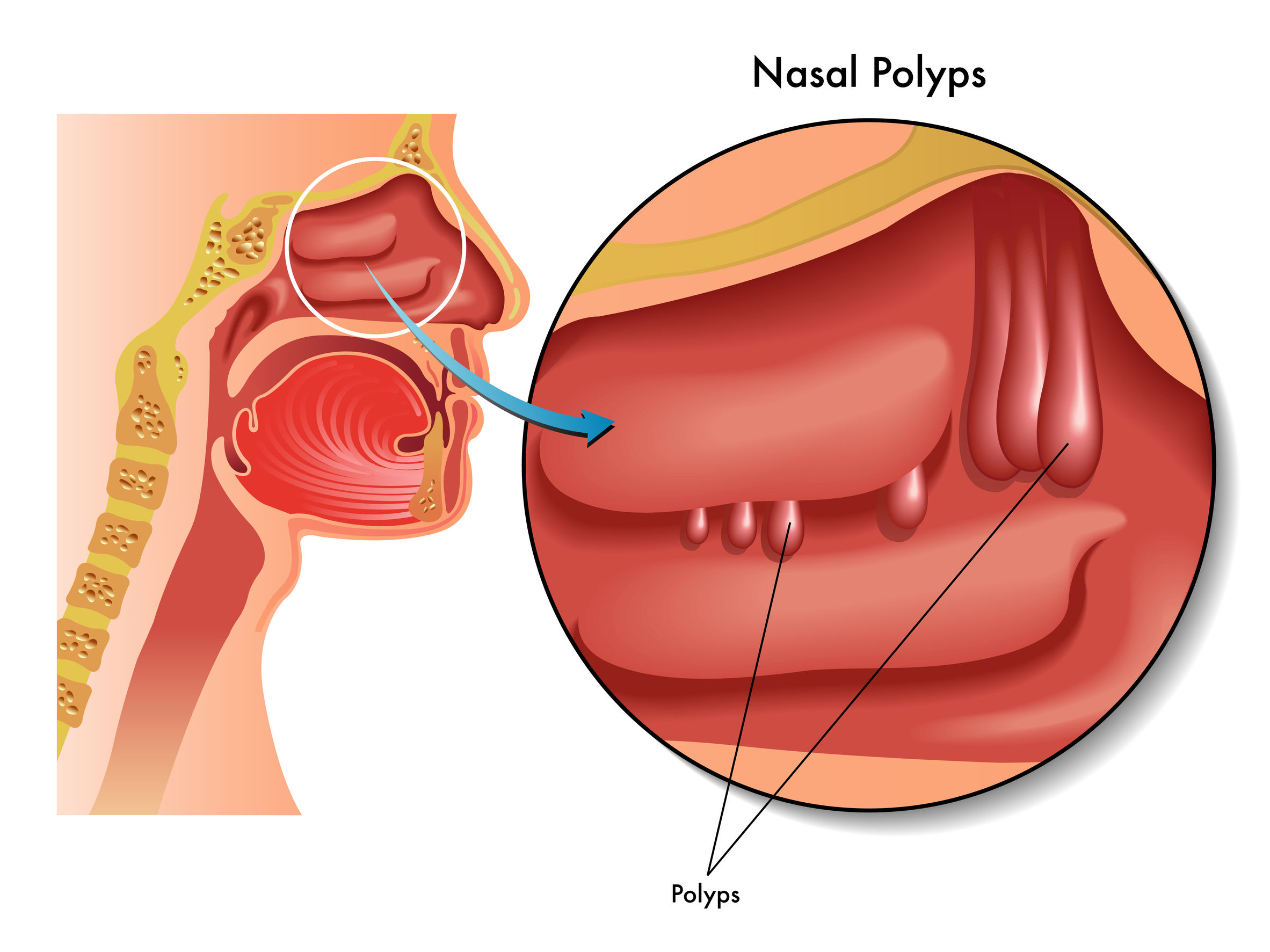 Nasal Polyps: Signs, symptoms and natural treatments