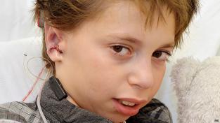 Médicos crean orejas para un niño a partir de sus costillas