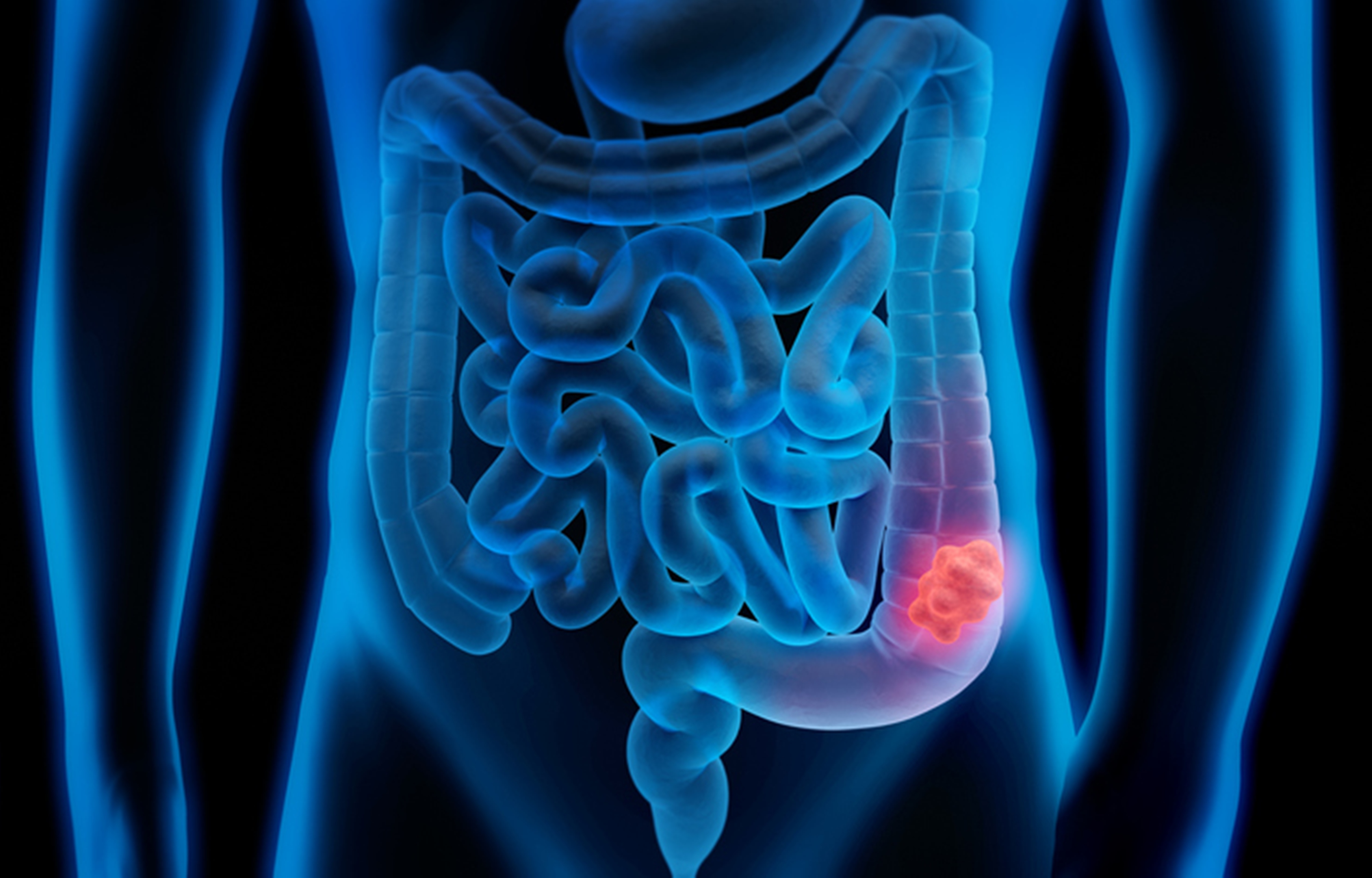  Cáncer colorrectal y COVID19: El 95% de los cánceres de colon tiene su origen en un pólipo