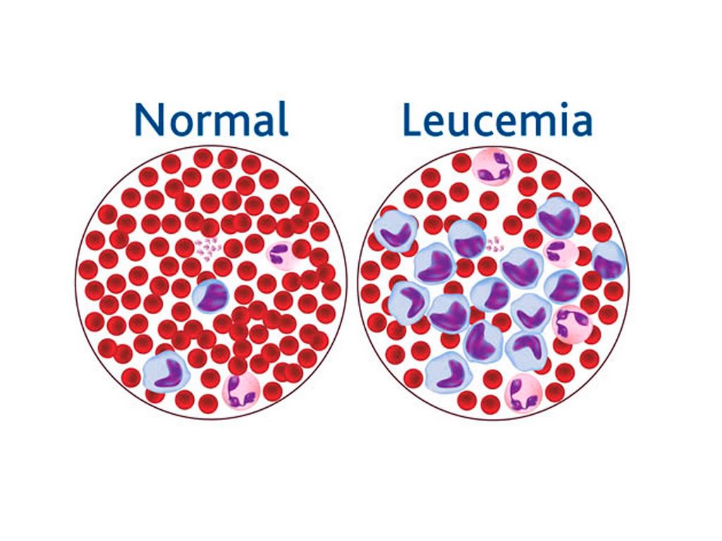 Síntomas de leucemia que son silenciosos y podrías pasarlos por alto