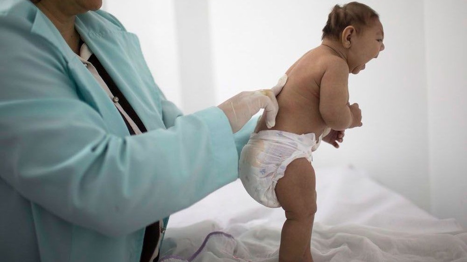 Zika definitely causes severe birth defects, CDC says