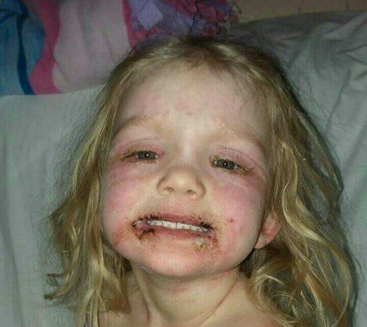 Nena de 3 años hospitalizada con graves heridas tras jugar con juguete 'inofensivo'