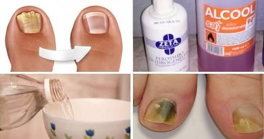 Elimina hongos y manchas amarillas en las uñas con este remedio casero