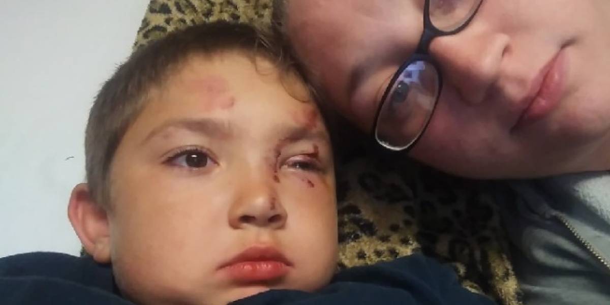 Niño autista de 6 años recibió brutal golpiza por defender a su amigo del bullying