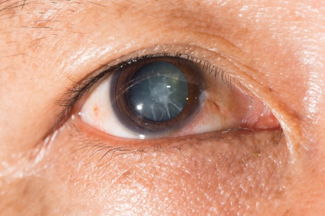 New Eye Drops Can Dissolve Cataracts With No Need For Surgery