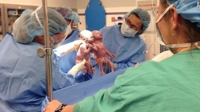 Una hermosa sorpresa: gemelas nacen tomadas de la mano
