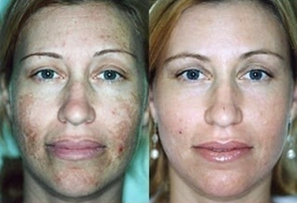 Microdermoabrasión casera para eliminar, manchas, acné, cicatrices y arrugas en 1 día