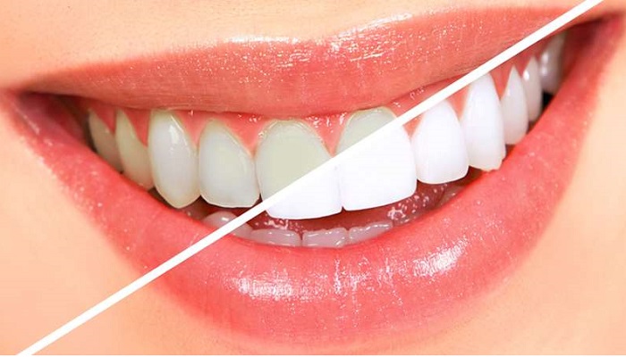 Puedes blanquear naturalmente tus dientes, aquí te decimos cómo y sin tratamiento clínico