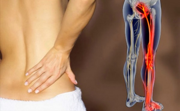 Natural Treatments For Sciatic Pain