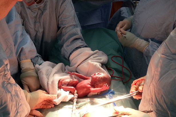 La foto de una bebé nacida tras 24 semanas de gestación demuestra la realidad del aborto