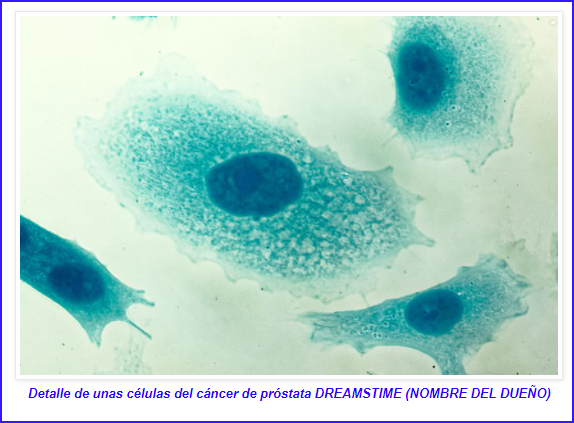  Hallan dos nuevos marcadores que predicen la agresividad del cáncer de próstata