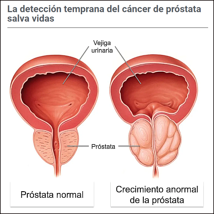 Cáncer de próstata: Indices de supervivencia