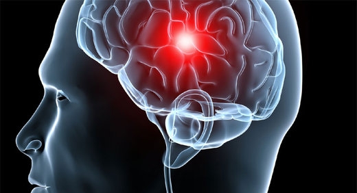 Síntomas que alertan de un derrame cerebral antes de que pase