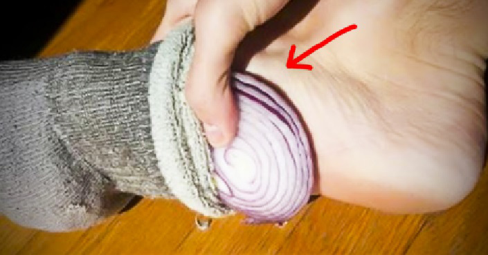 Para estar saludable aplica revestimiento de cebolla en los pies