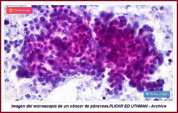  El color de la orina y la sed, los nuevos síntomas para detectar el cáncer de páncreas