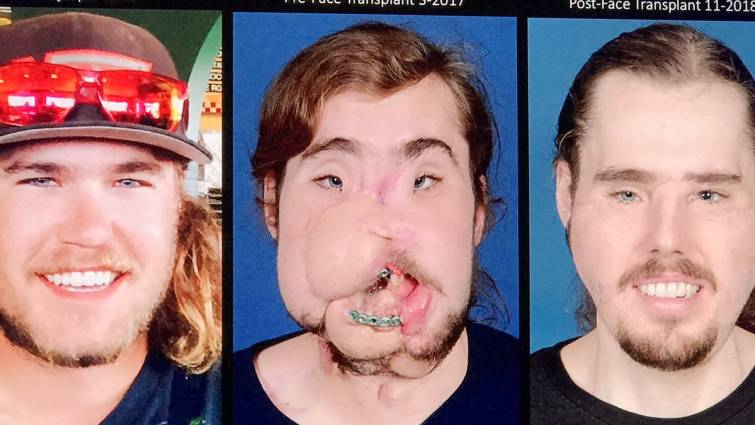 El antes y el después de un joven que se sometió a un trasplante de cara