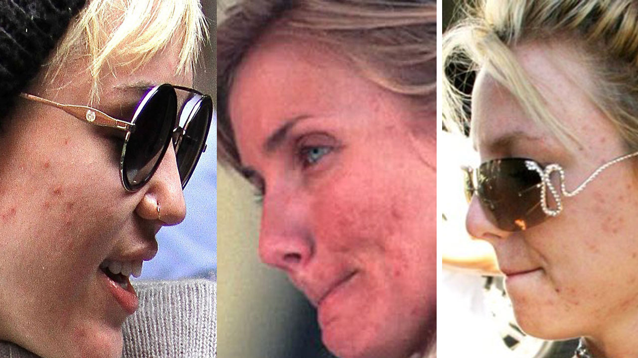 3 famosas que lucharon contra el acné y lograron recuperarse