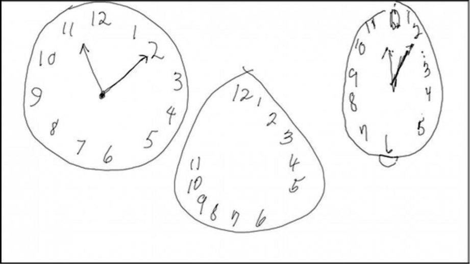 Dibujar un reloj, podría decirte si padeces párkinson o alzhéimer