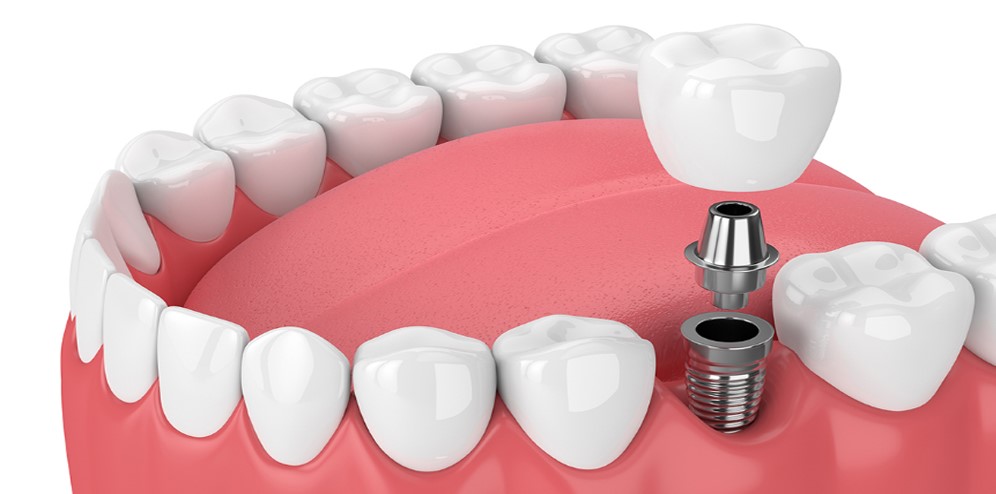 ¿Qué tipo de implantes dentales puedes hacerte?