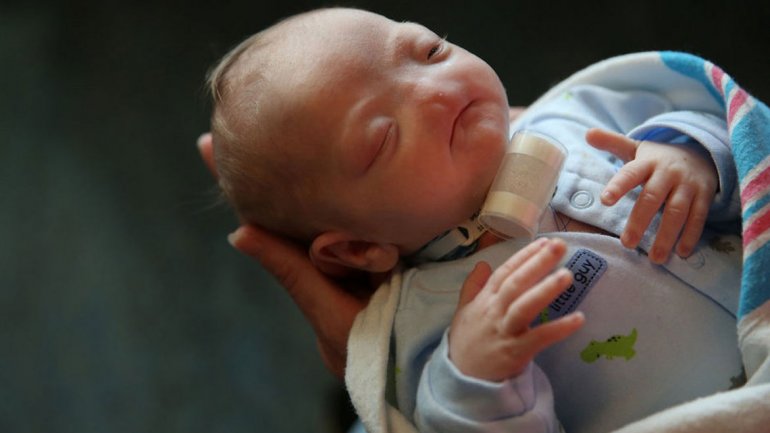 Historia de un bebé que nació sin nariz debido a una extraña condición