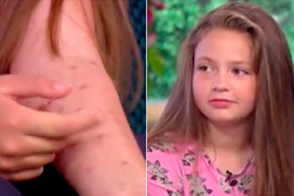 Facebook: niña sufrió terribles quemaduras tras aceptar este peligroso reto