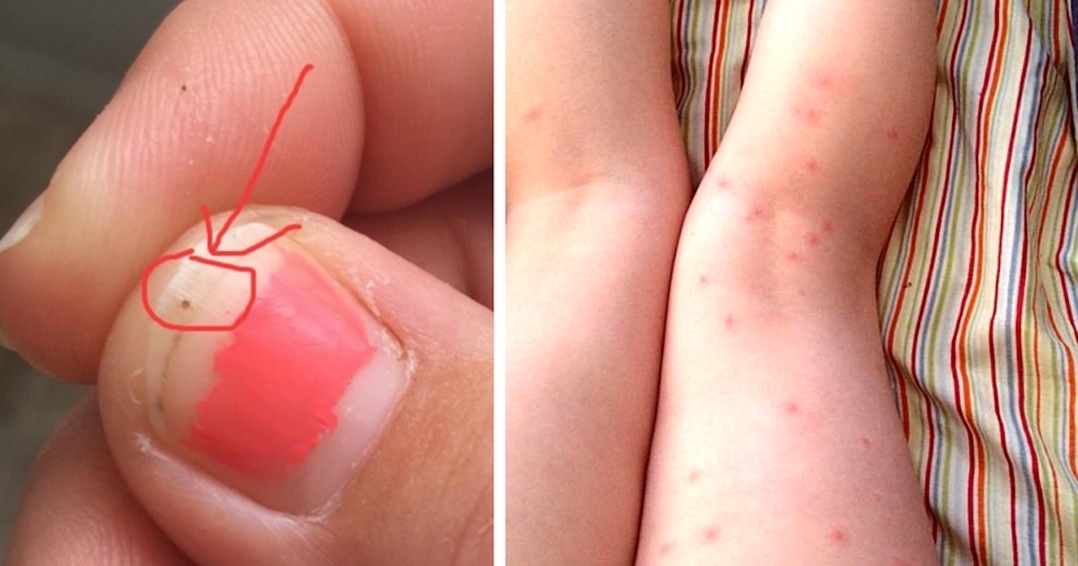 Mom notices strange dot on daughter's nail, 1 day later she   s rushed to the hospital