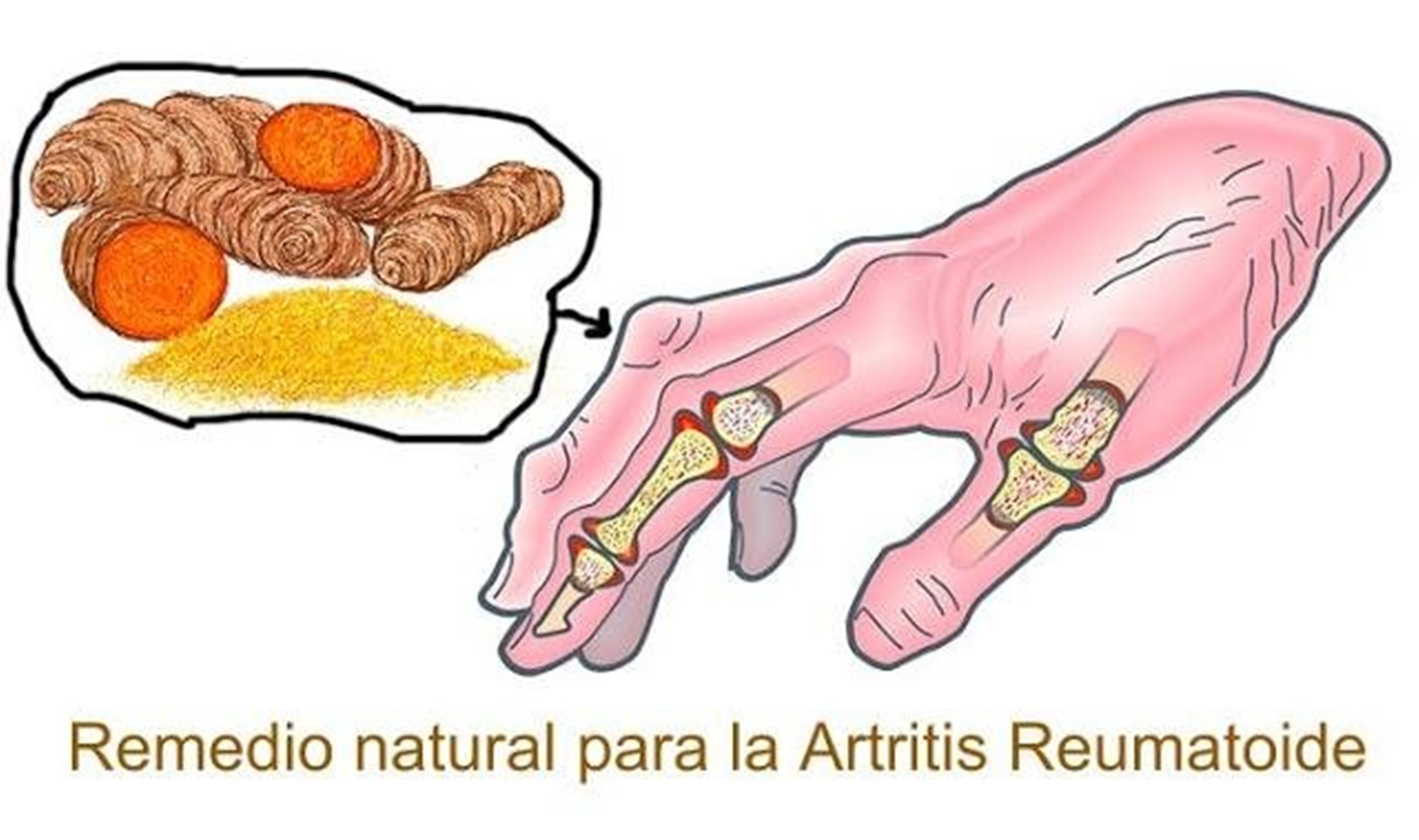  Artritis: Los 4 mejores remedios naturales para la artritis reumatoide