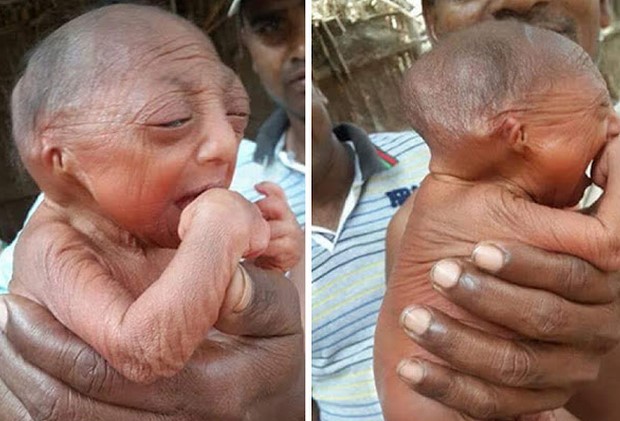 Este bebé nació con el aspecto de un anciano de 90 años
