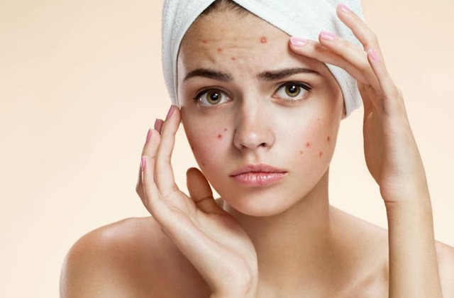 10 Tips for preventing Acne